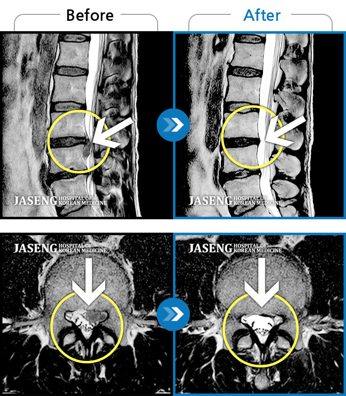 자생한방병원 치료사례 MRI로 보는 치료결과-왼쪽 발목과 엄지발가락 힘이 빠지면서 허리 통증