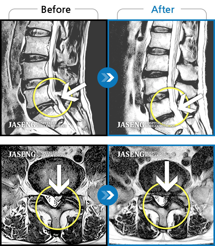 자생한방병원 치료사례 MRI로 보는 치료결과-처음 내원 시 서있기 힘들 정도의 심한 허리 통증 및 좌측 하지 통증으로 내원하셨습니다. 