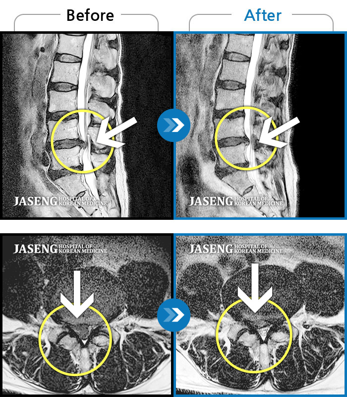 자생한방병원 치료사례 MRI로 보는 치료결과-일하다가 뜨끔한 후에 왼쪽 다리가 터질듯이 아파요. 발목힘이 빠져서 휠체어타고 왔어요