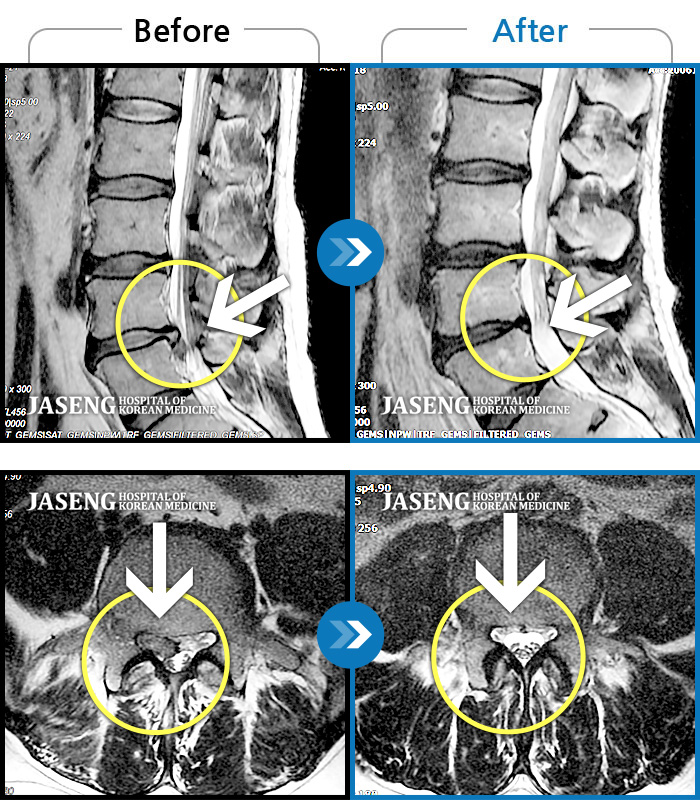 자생한방병원 치료사례 MRI로 보는 치료결과-걸으면 오른 다리가 콕콕 쑤시면서 아프듯이 저려요.