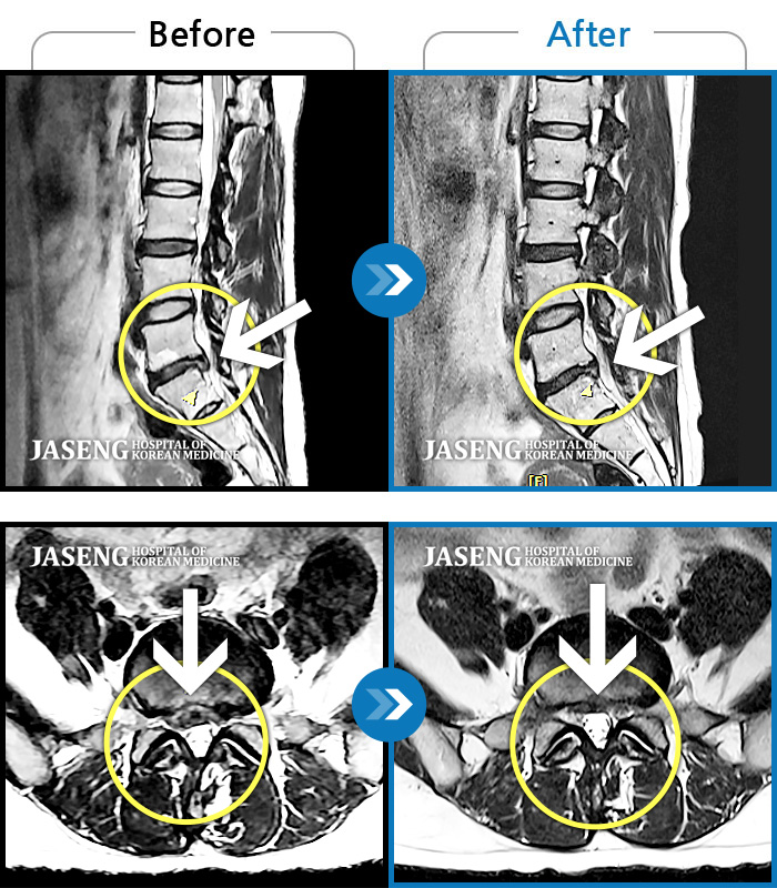 자생한방병원 치료사례 MRI로 보는 치료결과-허리 양측과 우측 골반 통증, 안정시에도 지속되는 우측 하지 부위 얼얼한 통증