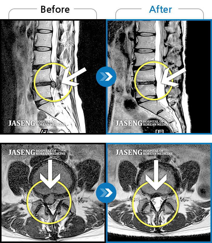 자생한방병원 치료사례 MRI로 보는 치료결과-통증과 다리 저림이 심해서 거동이 안되어 입원했어요.