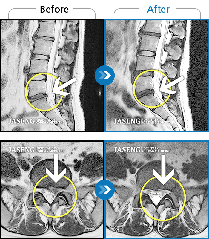 자생한방병원 치료사례 MRI로 보는 치료결과-좌측 허벅지 종아리가 전기오듯 당기고 발바닥 저림이 있었다.