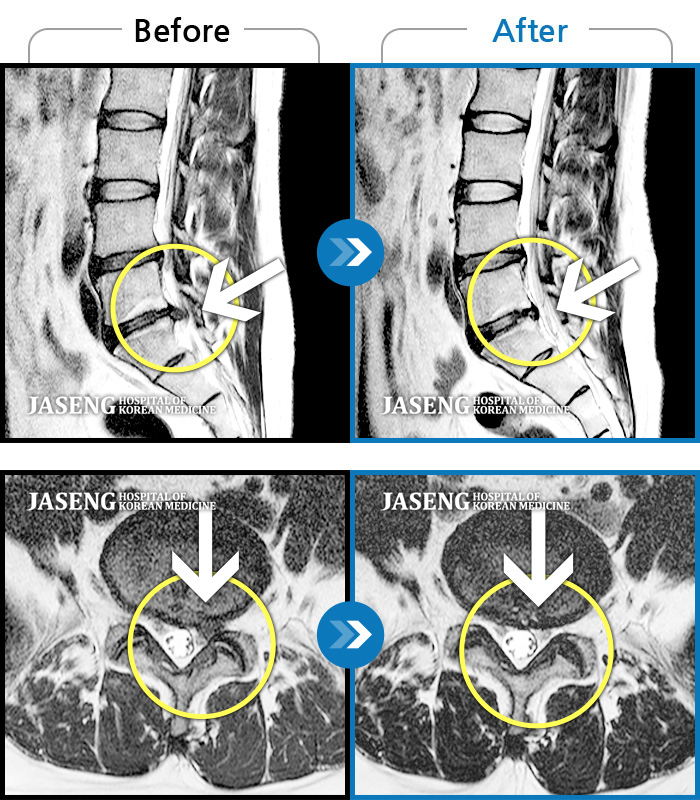 자생한방병원 치료사례 MRI로 보는 치료결과-앉지도 서지도 못하는 극심한 요통, 하지방사통으로 응급실 내원