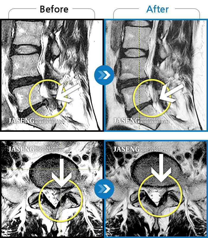 자생한방병원 치료사례 MRI로 보는 치료결과-왼쪽 엉덩이의 통증이 심해서 출산 후 일상생활이 힘들어요 