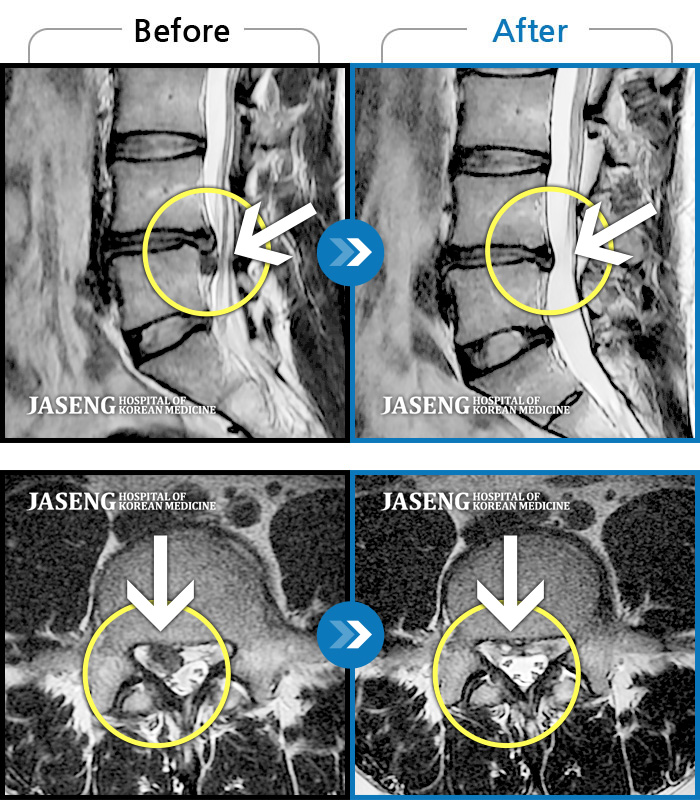 자생한방병원 치료사례 MRI로 보는 치료결과-우측 허리 골반이 아프고, 우측 다리가 저리고 당기며 힘이 빠진다.