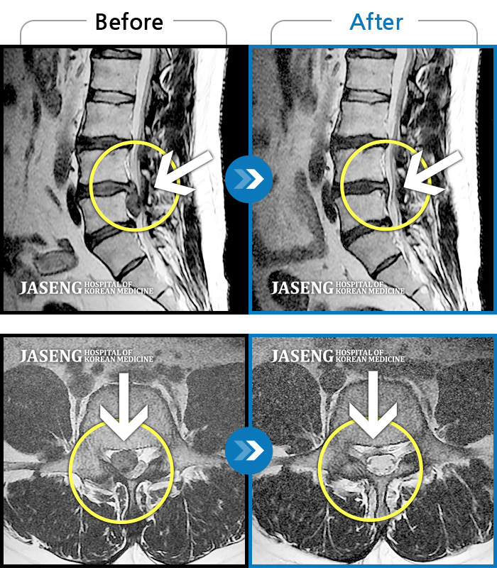 자생한방병원 치료사례 MRI로 보는 치료결과-허리와 우측다리가 심하게 저렸다.