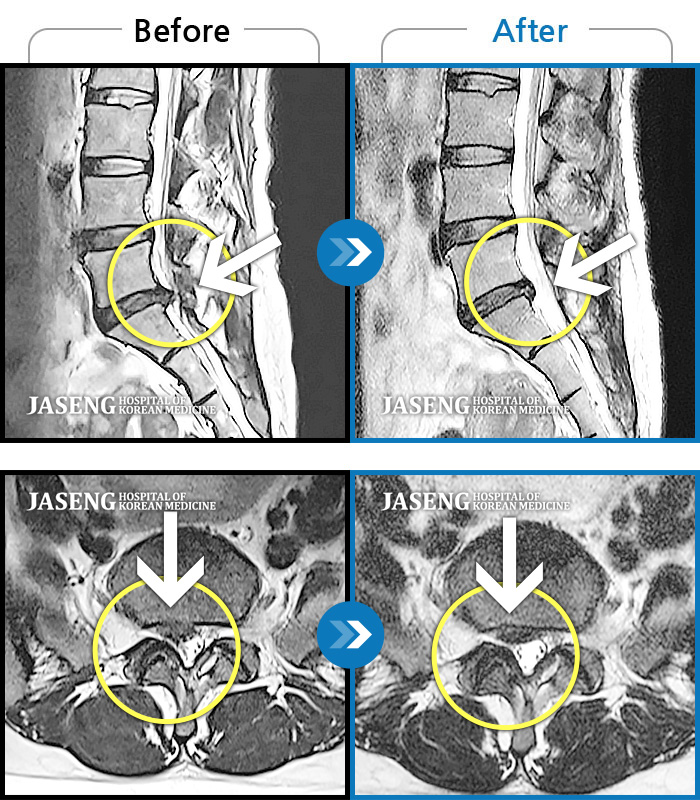 자생한방병원 치료사례 MRI로 보는 치료결과-우측 둔부 및 하지의 극심한 통증으로 업무 수행이 힘든 상태였습니다. 