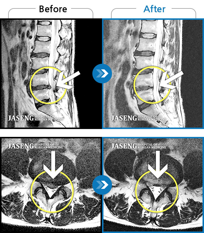 자생한방병원 치료사례 MRI로 보는 치료결과-처음 내원시 심한 허리 통증과 오른쪽 엉덩이부터 허벅지 종아리까지 저리고 당기는 증상을 호소하셨습니다.