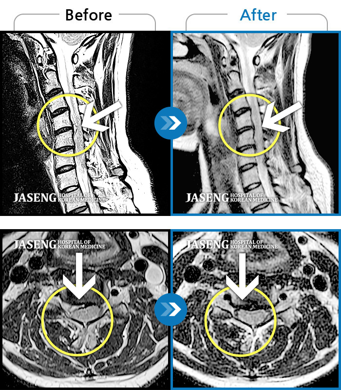 자생한방병원 치료사례 MRI로 보는 치료결과-오른팔을 거의 올리지 못하고 목과 팔 통증 극심