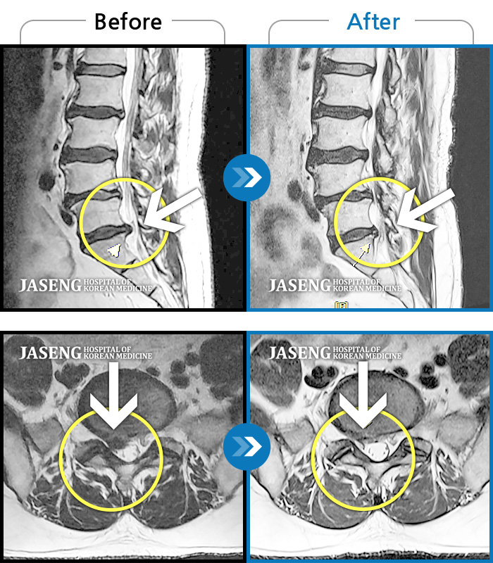 자생한방병원 치료사례 MRI로 보는 치료결과-허리 우측부터 골반까지 통증, 우측 하지 저림 증상 