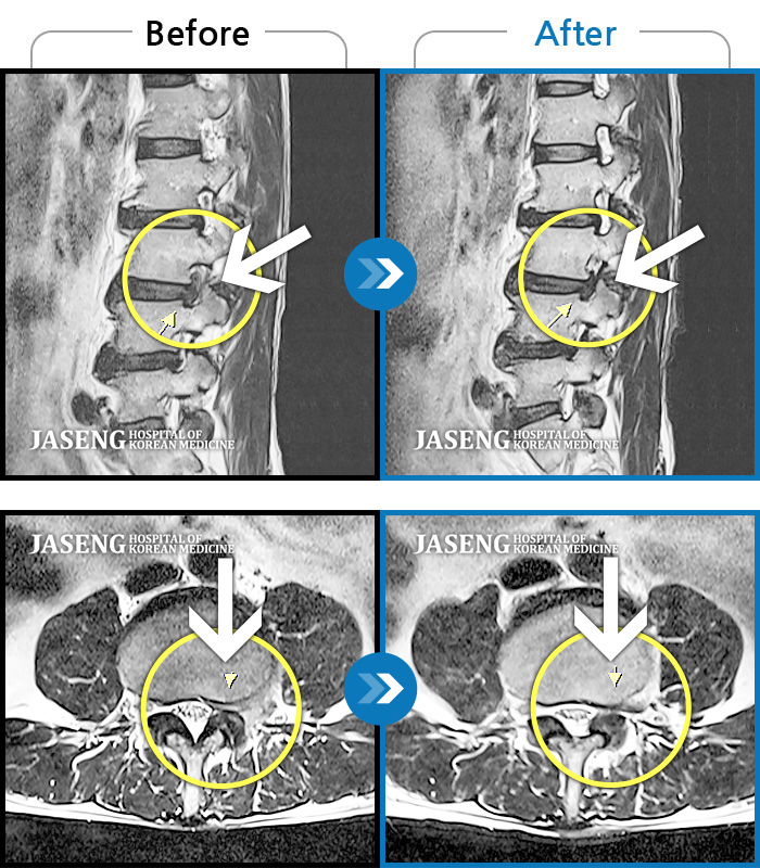자생한방병원 치료사례 MRI로 보는 치료결과-허리 좌측부터 골반까지 무거운 통증, 옆으로 누우면 당기는 증상  