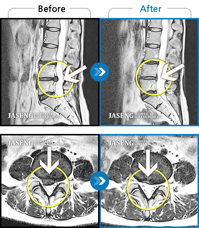 자생한방병원 치료사례 MRI로 보는 치료결과-허리 우측부터 골반까지 통증, 양측 골반 틀어짐