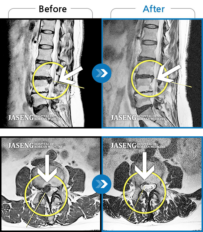 자생한방병원 치료사례 MRI로 보는 치료결과-허리 오른쪽에서 오른쪽 골반까지 찌르는 듯한 통증