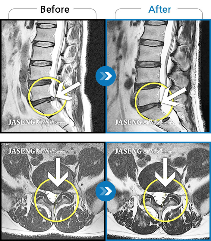 자생한방병원 치료사례 MRI로 보는 치료결과-요추부~좌측 엉치~종아리 후면 저리고 당김