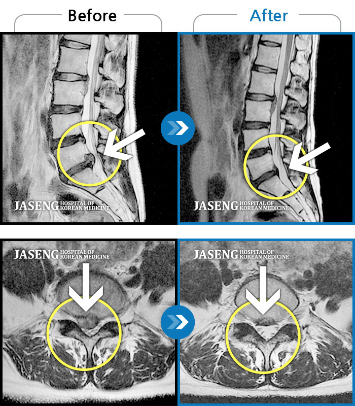 자생한방병원 치료사례 MRI로 보는 치료결과-극심한 허리와 좌측 하지 방사통 및 마비감으로 모든 자세가 힘들었다.