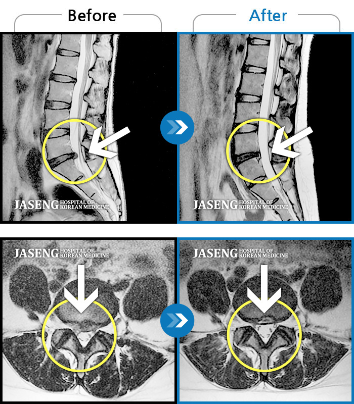자생한방병원 치료사례 MRI로 보는 치료결과-허리가 끊어질 것 같은 통증에 앉거나 눕기도 어려운 상태였습니다. 또한 양쪽 다리 모두 다리로 내려가는 방산통이 심했습니다.