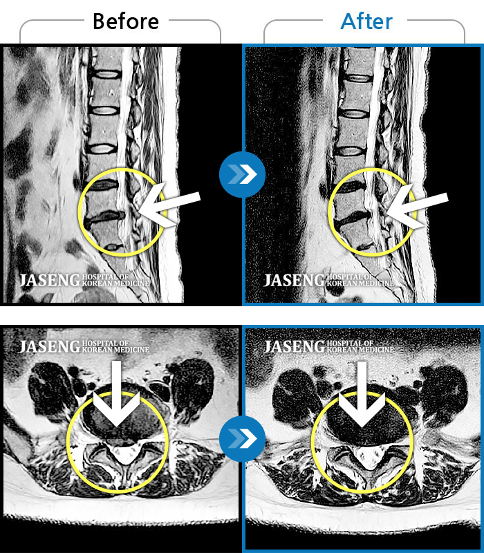 자생한방병원 치료사례 MRI로 보는 치료결과-움직이지 못할 정도로 허리통증이 심해요. 