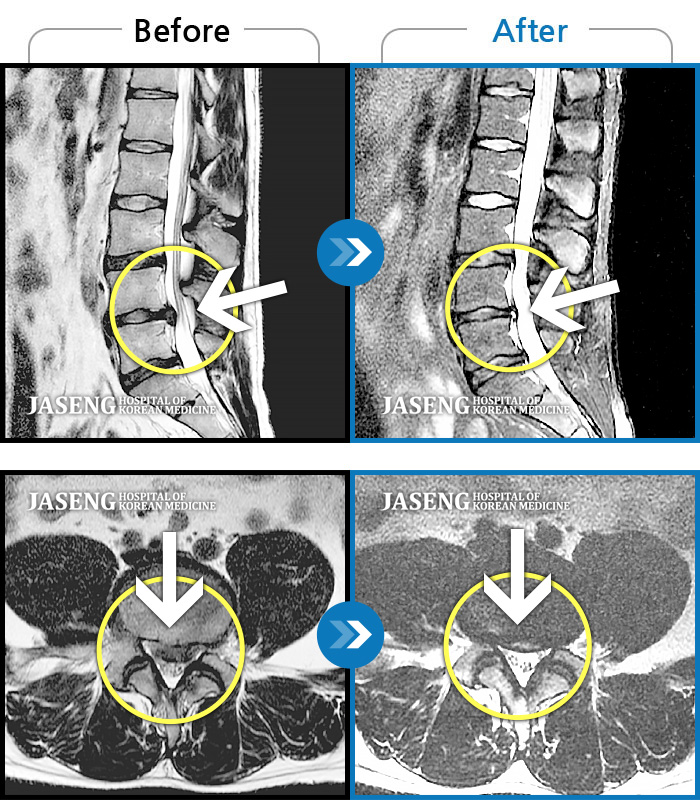자생한방병원 치료사례 MRI로 보는 치료결과-일어서다 삐끗 한 후 골반과 고관절 통증이 심하여 일상생활이 불가능 했었습니다.