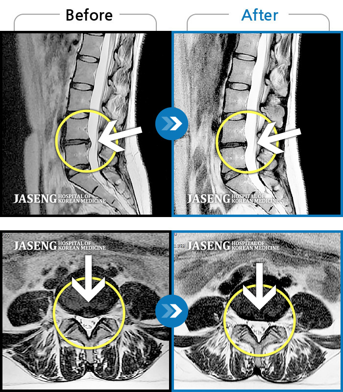 자생한방병원 치료사례 MRI로 보는 치료결과-허리 통증이 심해서 의자에 앉기도 힘들었어요