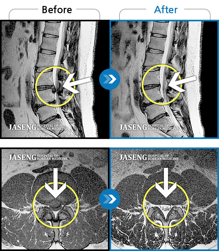 자생한방병원 치료사례 MRI로 보는 치료결과-우측 허리, 엉치 통증으로 활동하기 힘든 상태