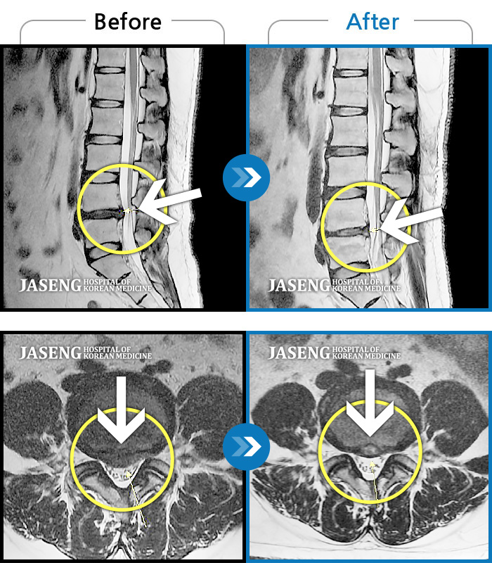 자생한방병원 치료사례 MRI로 보는 치료결과-양측 하요추부 통증과 양측 하지 저림