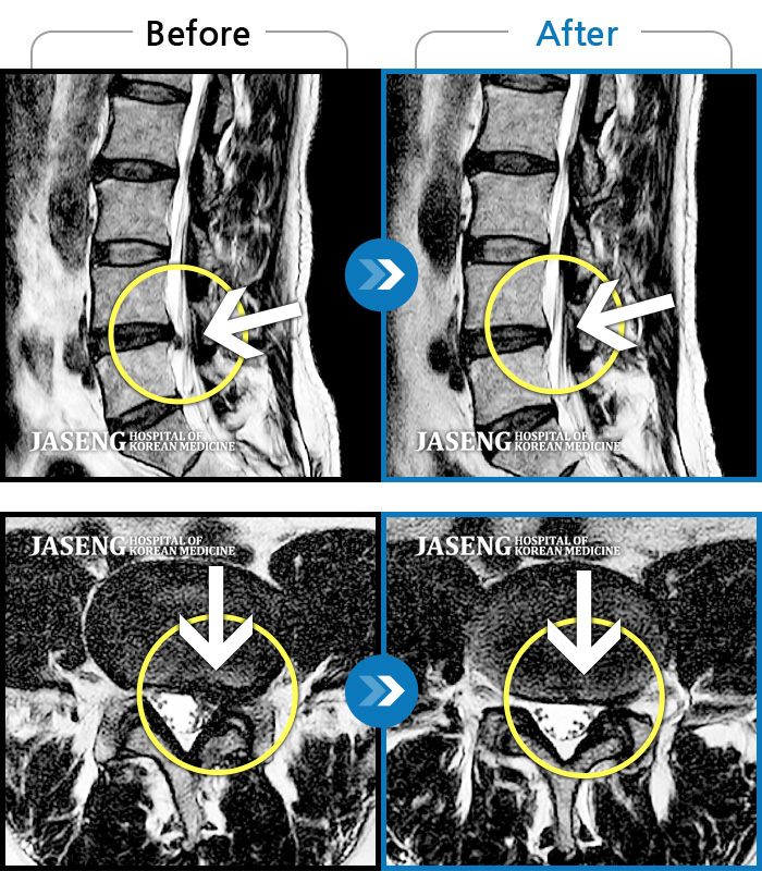 자생한방병원 치료사례 MRI로 보는 치료결과-허리와 왼쪽 고관절 통증이 특히 심하고 왼쪽 다리가 저려요.