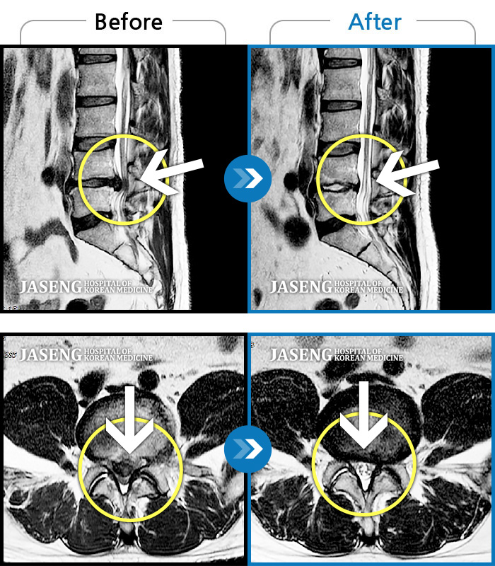 자생한방병원 치료사례 MRI로 보는 치료결과-허리 통증과 다리 저림이 심해 걷지도 앉지도 못하겠어요