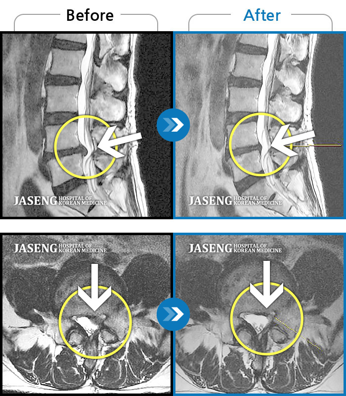 자생한방병원 치료사례 MRI로 보는 치료결과-허리 통증과 좌측 둔부 및 하지 방사통 극심하여 일상생활 불가 및 눕기도 힘든 상태로 내원