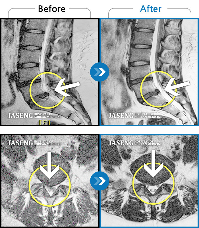 자생한방병원 치료사례 MRI로 보는 치료결과-처음 내원시 약 1년 가까이 지속된 허리 통증 및 다리 저림으로 앉아있을 때 통증이 심한 상태였습니다