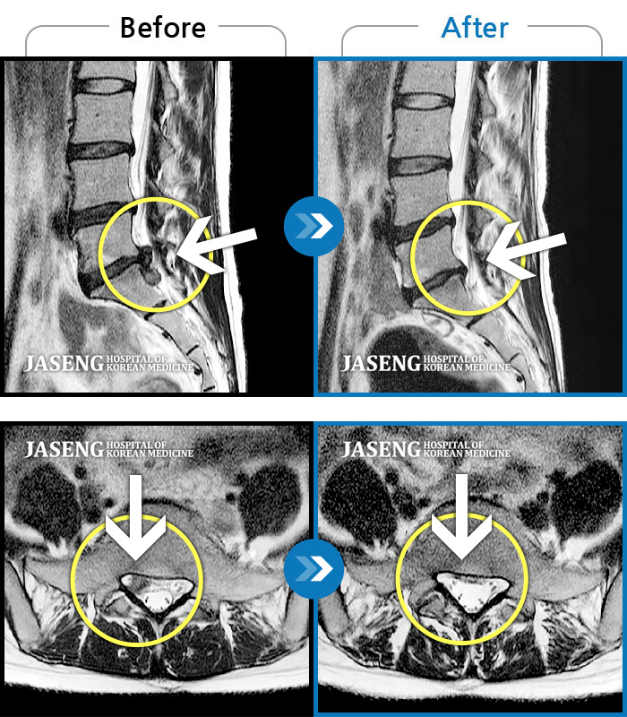 자생한방병원 치료사례 MRI로 보는 치료결과-처음 내원 시 허리 통증 및 우측 다리 저림이 심하여 일상생활이 불가능