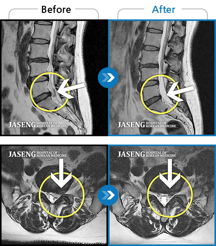 자생한방병원 치료사례 MRI로 보는 치료결과-왼쪽 종아리가 많이 당기고 걸을 때 절뚝거림이 심했습니다.