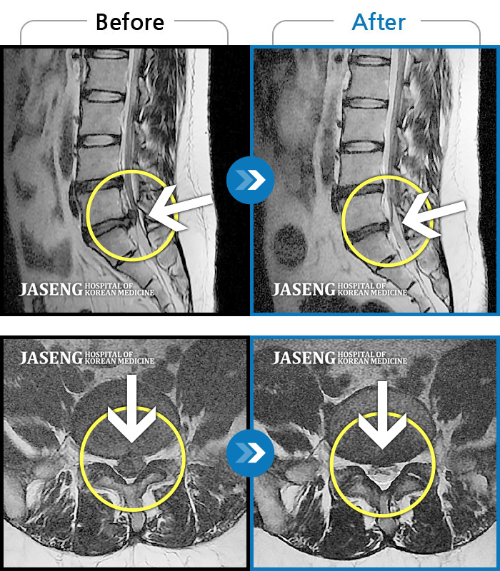 자생한방병원 치료사례 MRI로 보는 치료결과-처음 내원 시 허리, 엉덩이가 많이 아프고, 양측 다리가 저리고 당겨서 정상적인 보행이 힘든 상태 