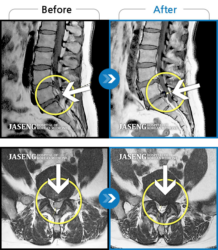 자생한방병원 치료사례 MRI로 보는 치료결과-좌측 하지 외측이 저리면서 당김증상 및 감각둔화