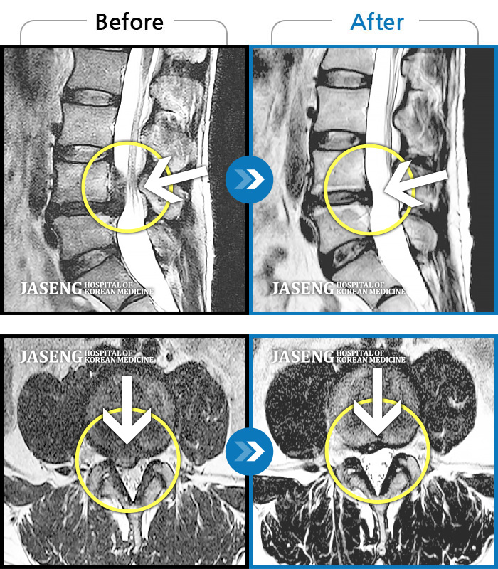 자생한방병원 치료사례 MRI로 보는 치료결과-우측 허리 통증, 우측 하지 방사통, 근력저하 및 저림 증상을 동반하여 내원하였습니다.