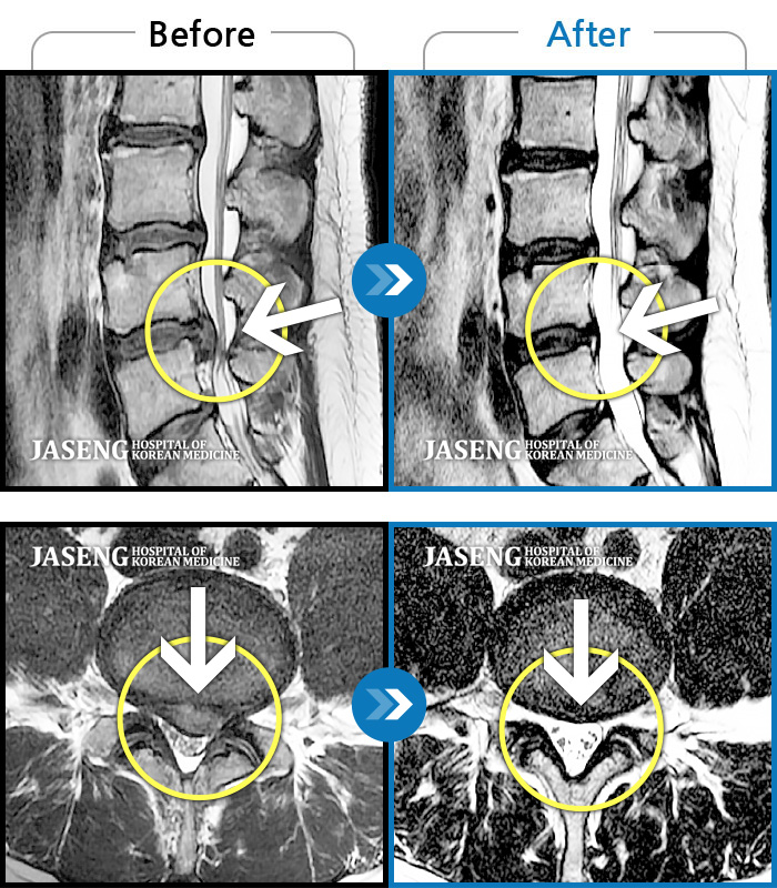 자생한방병원 치료사례 MRI로 보는 치료결과-양측 허리 통증, 좌측 하지 견인통 및 저림 증상을 동반하여 내원하였습니다.