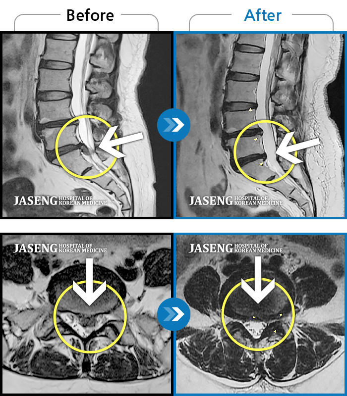 자생한방병원 치료사례 MRI로 보는 치료결과-하부요추 뻐근하고 묵직한 통증
