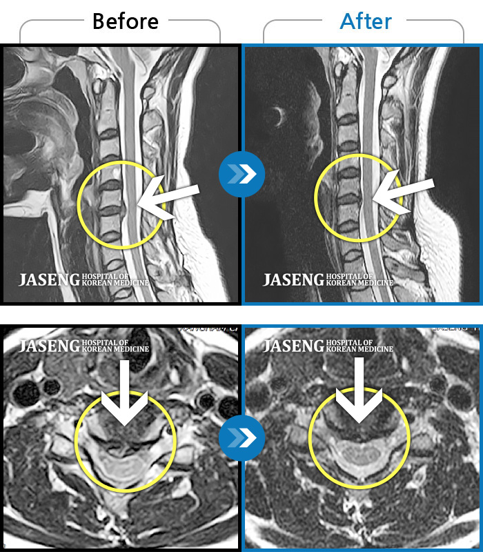 자생한방병원 치료사례 MRI로 보는 치료결과-목  통증이 심해 고개를 돌리기 어려웠습니다