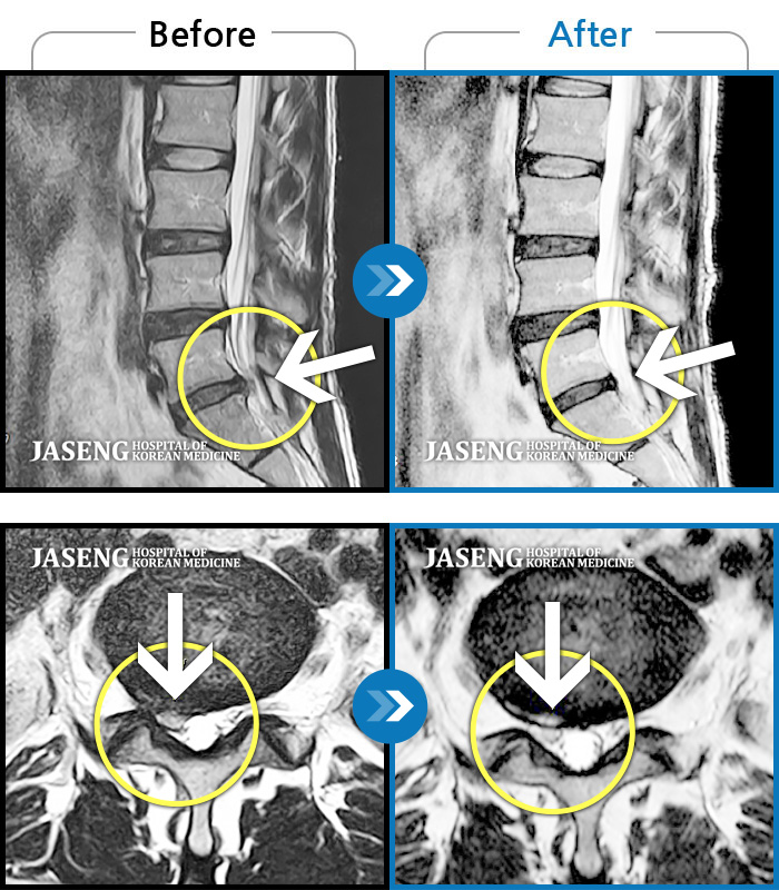 자생한방병원 치료사례 MRI로 보는 치료결과-처음 내원 시 통증과 저림이 심해 자가보행 및 일상생활이 불가능한 상태