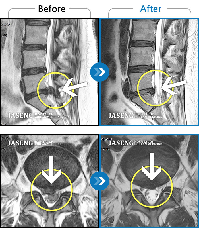 자생한방병원 치료사례 MRI로 보는 치료결과-집에서 무거운 물건 들다 삐끗한 후 허리디스크가 터지고 흘러내려 극심한 통증을 호소하셨습니다