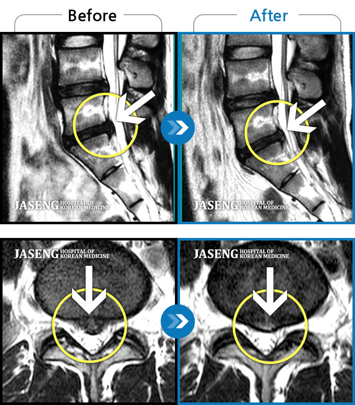 자생한방병원 치료사례 MRI로 보는 치료결과-허리 아래쪽 아프고 좌측 허리 다리가 저리고 통증이 심해 허리를 펼수가 없었다.
