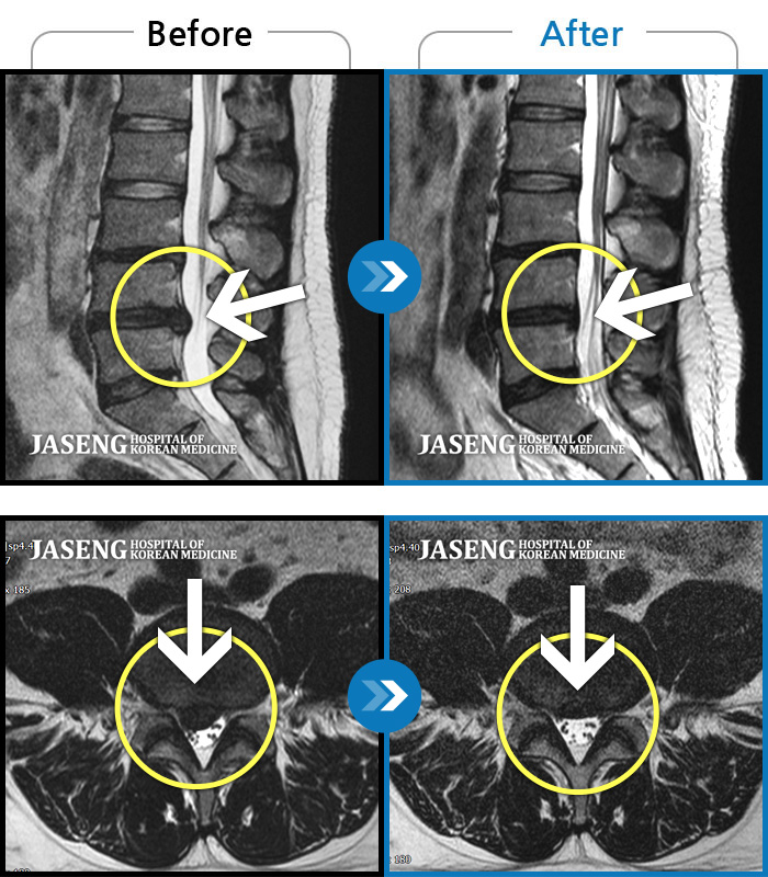 자생한방병원 치료사례 MRI로 보는 치료결과-처음 내원시 우측 골반 및 종아리 통증으로 걷기 및 허리 굴신이 어려운 상태였습니다