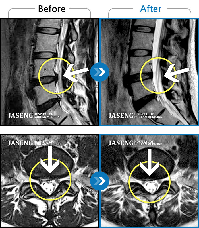 자생한방병원 치료사례 MRI로 보는 치료결과-양측 하지 통증 및  저림감이 하루 종일 지속되어 일상생활이 어려워요