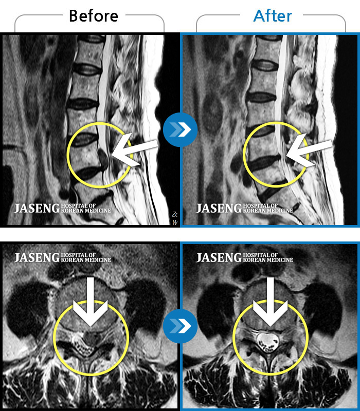 자생한방병원 치료사례 MRI로 보는 치료결과-허리 골반이 욱신욱신하게 아프고 허리 숙일 때 다리가 당겼다.