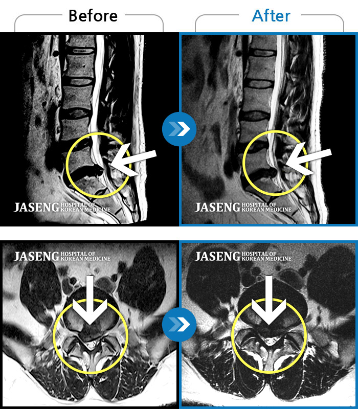 자생한방병원 치료사례 MRI로 보는 치료결과-통증 때문에 휴직 후 여러 치료에도 호전이 없던 다리 통증 및 저림