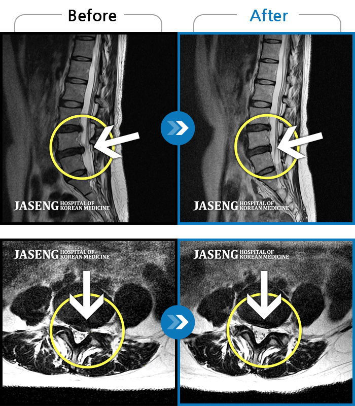 자생한방병원 치료사례 MRI로 보는 치료결과-수개월간 지속된 허리 통증이 악화