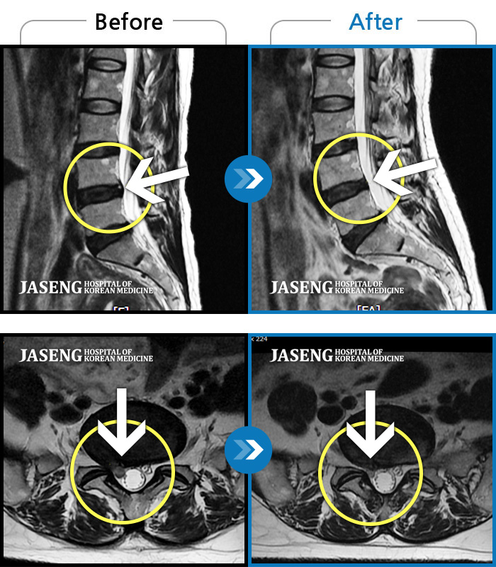 자생한방병원 치료사례 MRI로 보는 치료결과-하요추부 통증과 하지 저림