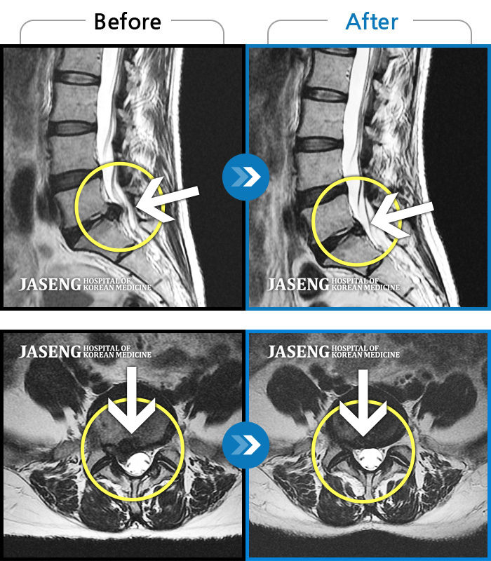 자생한방병원 치료사례 MRI로 보는 치료결과-우측 허리와 골반이 아프고, 우측 둔부와 다리에 통증과 저림이 있었다.