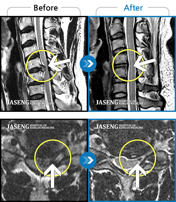자생한방병원 치료사례 MRI로 보는 치료결과-자고 일어난 후 발생한 극심한 후경부 통증 및 좌측 상완부의 저림