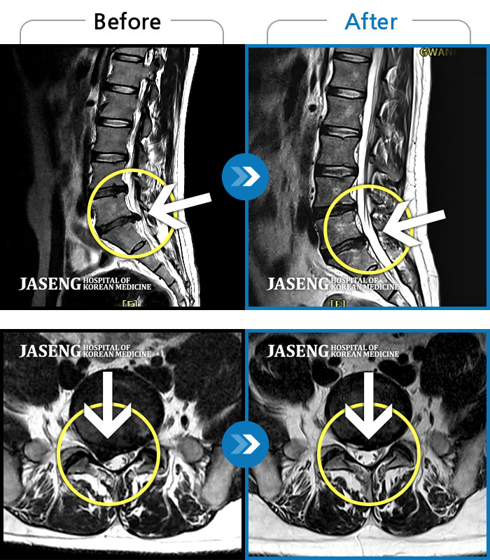 자생한방병원 치료사례 MRI로 보는 치료결과-양측 허리 통증, 우측 다리까지 이어지는 통증과 저림, 모든 자세에서 통증 심화